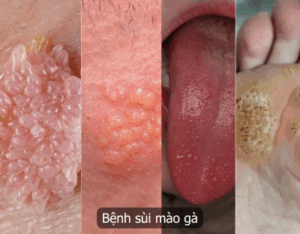 Bệnh sùi mào gà