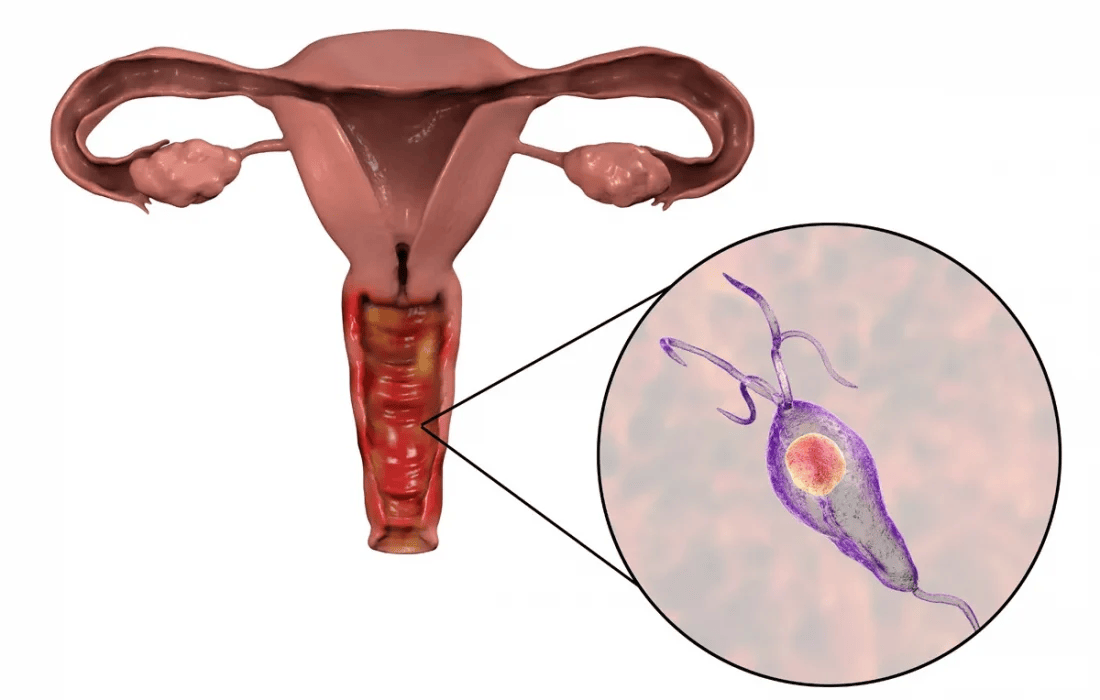 Trichomoniasis Overview
