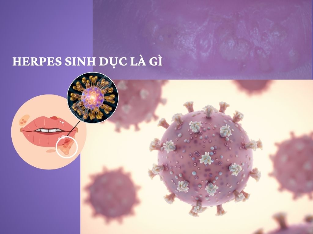 HERPES Sinh dục (HSV): Kiến Thức Toàn Diện