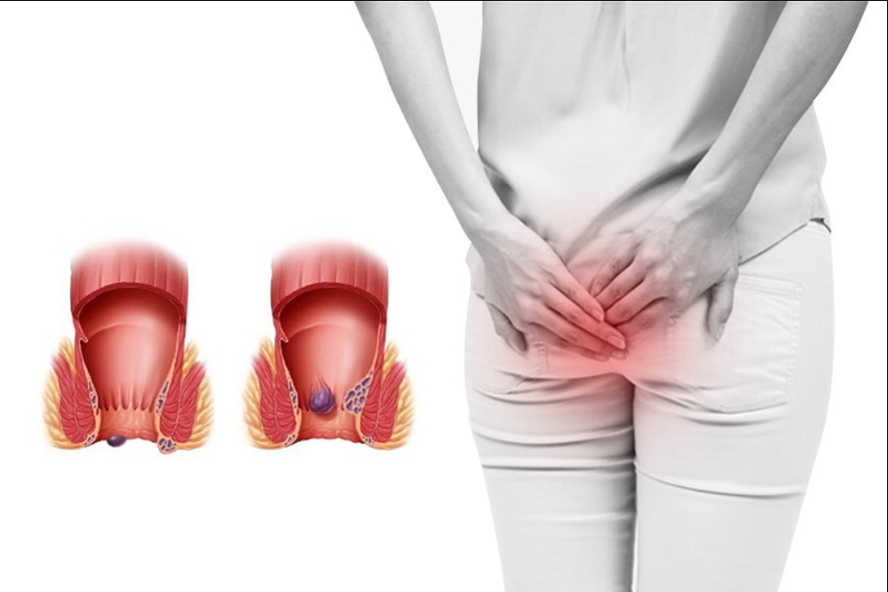 Lậu hậu môn – Triệu chứng thường bị bỏ qua ở người đồng tính nam