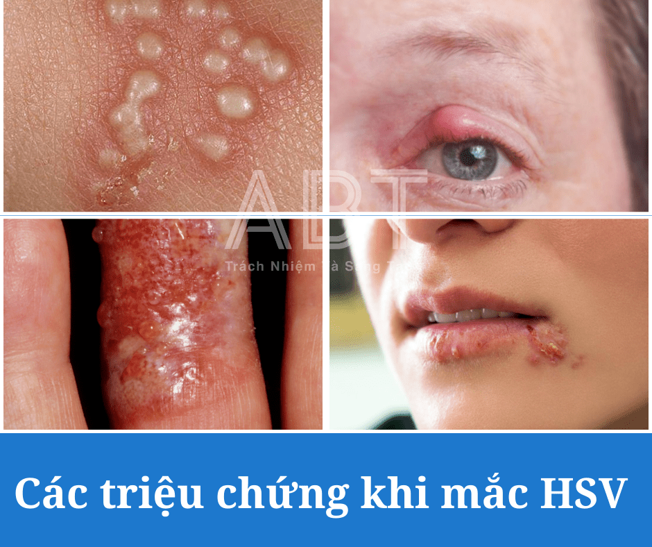 HERPES: Nguyên nhân, Triệu chứng, Chẩn đoán và Phân biệt
