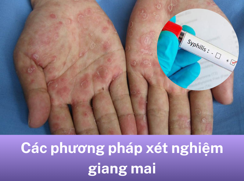 xét nghiệm giang mai