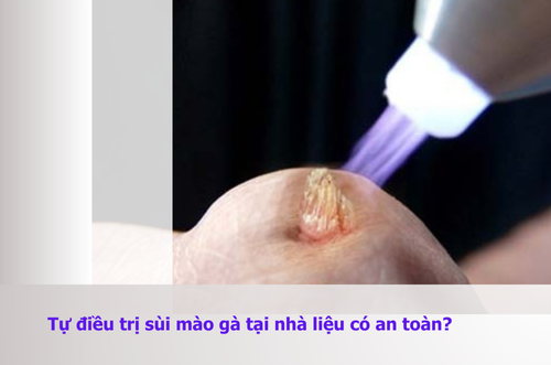 Có thể điều trị sùi mào gà tại nhà được không?